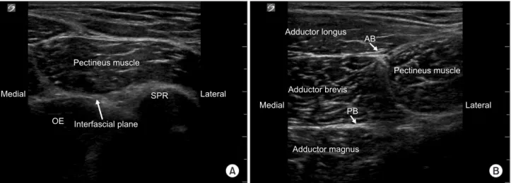 Fig. 3. Ultrasound images of the short axis view of proximal (A) and distal (B) obturator nerve block