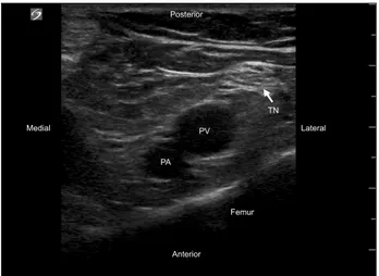 Fig. 4. Ultrasound image for infiltration between the popliteal artery  and capsule of the posterior knee block