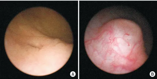 Fig. 1.  (A) preoperative cystoscopic find- find-ing, (B) competent ureteral orifice on  the top of a “volcano” after injection of  polymethylmethacrylate/dextranomer  injection.