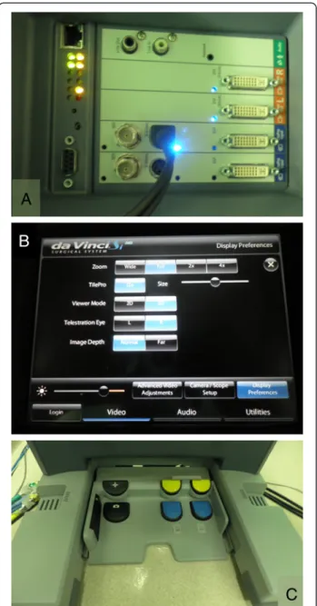 Figure 1 Tilpro ™ set up. (A) The posterior view of the da Vinci Surgical System input device for endoscopic video output