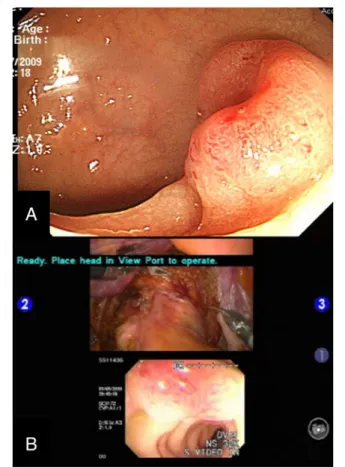 Figure 2 Preoperative colonoscopy and multi-input view of intraoperative colonoscopy. (A) The preoperative colonoscopic image