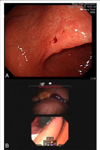 Figure 3 Preoperative upper endoscopy and multi-input view of intraoperative upper endoscopy