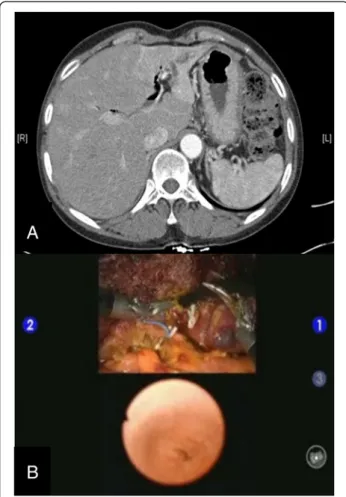 Figure 4 Images from a preoperative abdominal CT scan and multi-input view of intraoperative common bile duct exploration