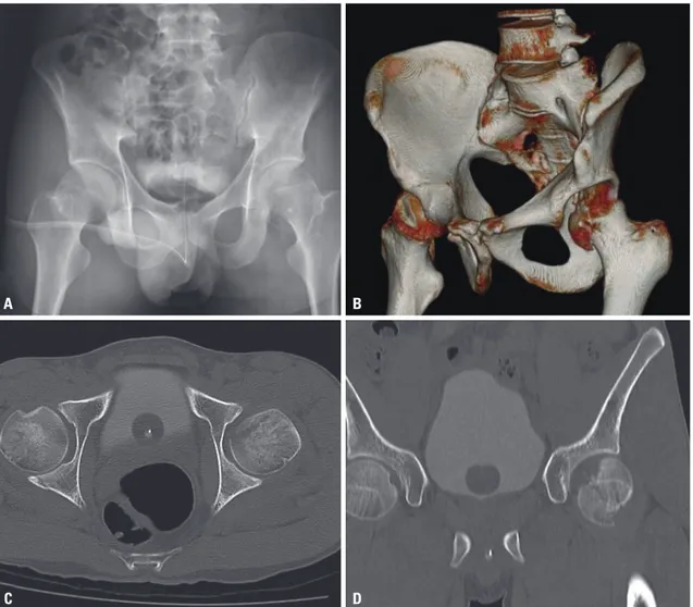 Fig. 1.  (A) Plain radiograph showing femoral head fracture. (B and C) CT scan showing Pipkin type II femoral head fracture