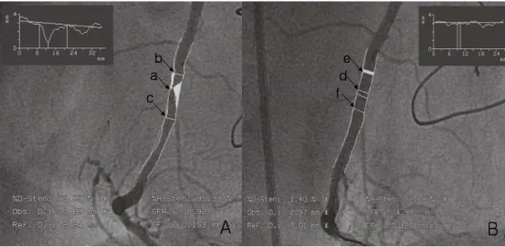 Figure  2.    Quantitative  angiographic  analysis.  Selected  images  for  analysis  were  identified  by  angiographic  projection  that  demonstrated  the  stenosis  in  an  unforeshortened view, minimized the degree of vessel overlap