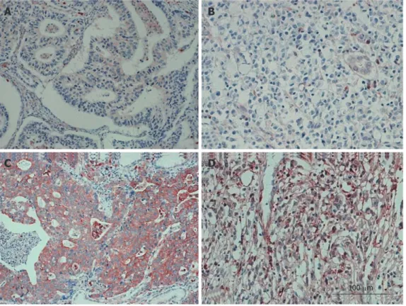 Figure 2  Representative images from immunohistochemistry assays of 368 archived gastric cancer cases at 20 × 10 magnification