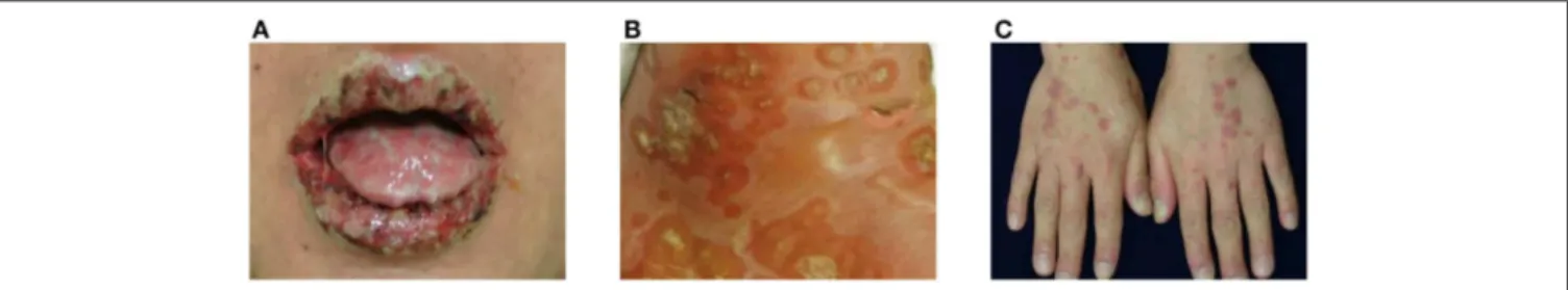 FIGURE 1 | Clinical manifestations of paraneoplastic pemphigus (PNP). (A) Extensive erosions with ulcers and crusts are shown on the vermilion borders of the lips