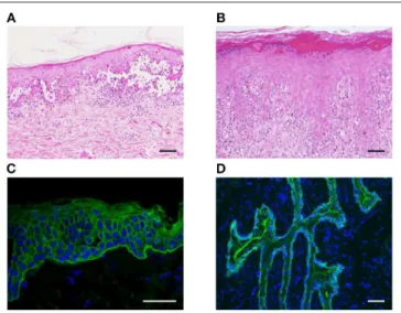 FIGURE 3 | Histopathological and immunofluorescent findings of PNP. (A,B) Suprabasal acantholysis (A) and interface dermatitis with scattered dyskeratotic cells (B) are observed in PNP skin lesions (scale bar, 100 µm)