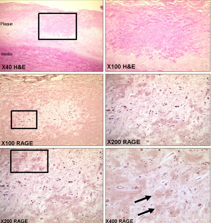 Figure 1.  Immunohistochemistry of RAGE in human carotid atheroma. RAGE was stained as dark brown within atheromatous plaques