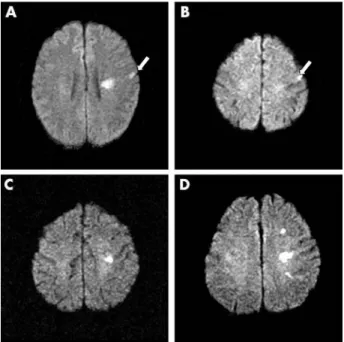 Figure 1 Diffusion weighted MRI images of WMM infarcts. Concomitant cortical embolic signals are shown (arrow in A and B)