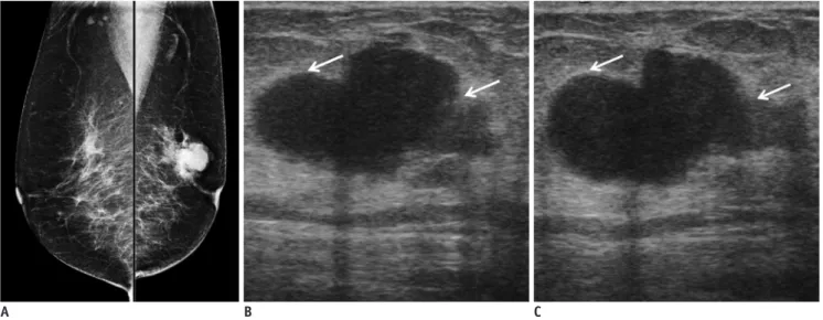 Fig. 3. 77-year-old woman with palpable mass in her left breast.