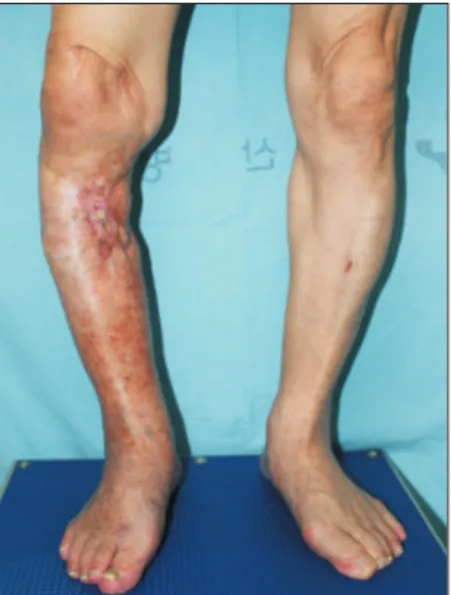 Fig. 1.  Preoperative view. The chronic wound of right lower extremity 