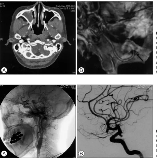 Fig.  2. A  right  ICA  angiogram  (A) demonstrates  a  persistent  primitive hypoglossal  artery  originating  from  the ICA  at  the  C-2  vertebral  level