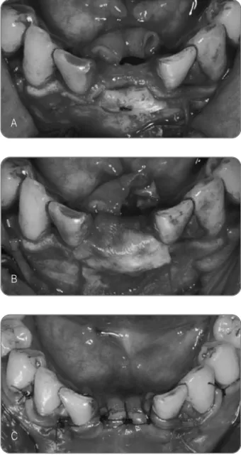 Fig. 3. A. Block bone was fixed with 7mm screw onto     the recipient bed.