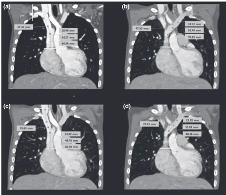 Figure 1 3D chest CT angiography showing how the vein lengths were measured: (a) right subclavian vein; (b) left subclavian vein; (c) right internal jugular vein; (d) left internal jugular vein.