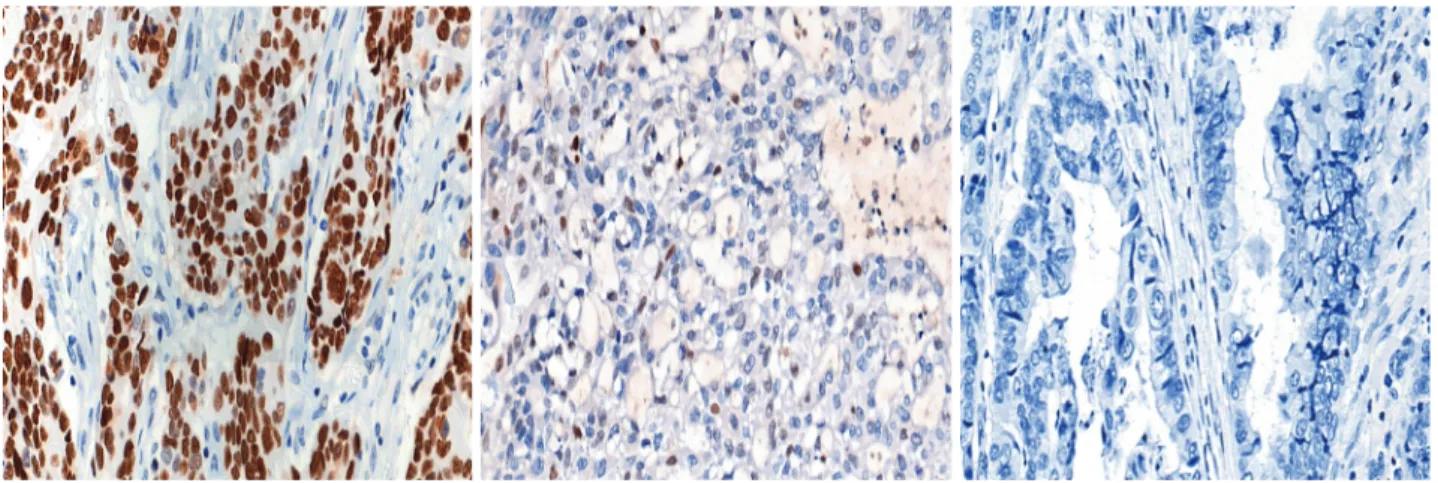 Table 1 summarizes the p53 IHC results according to TP53  mutations. TP53 mutations were present in 52 cases (43.3%),  of which missense mutations were the most common (33 of 52 