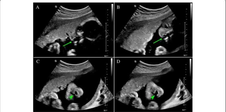 Fig. 1 Transabdominal ultrasonography of Case 1, 26 weeks ’ gestation. a, b: Arrow indicates the cleft palate site