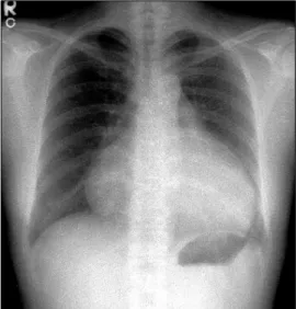 Fig. 2. Echocardiography showing a large amount of per- per-icardial effusion.