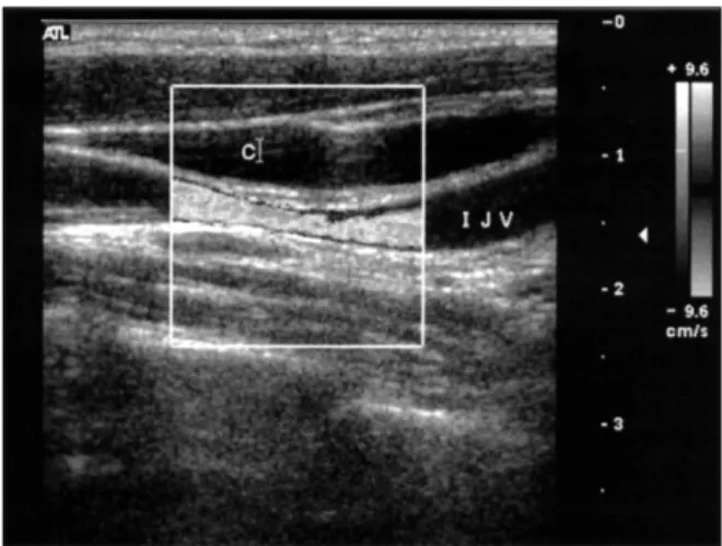 Fig. 5. Six months follow-up chest X-ray showing nearly normal size of heart.