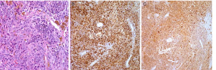 Fig. 2.   (A) Highly atypical sheets of malignant cells reveal sufficient granular cytoplasm and prominent eosinophilic nucleoli