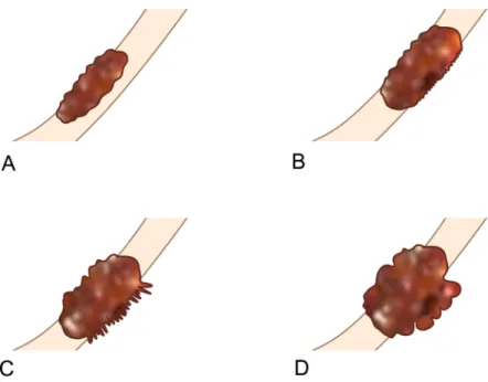 Fig 1. Schematic illustration showing four different groups of computed tomography (CT)-tumor depth