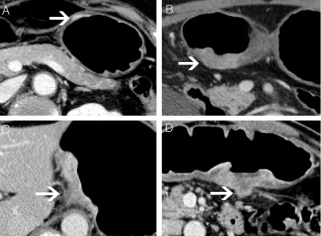 Fig 2. Axial images of contrast enhanced computed tomography (CT) demonstrating four different groups of CT-tumor depth.