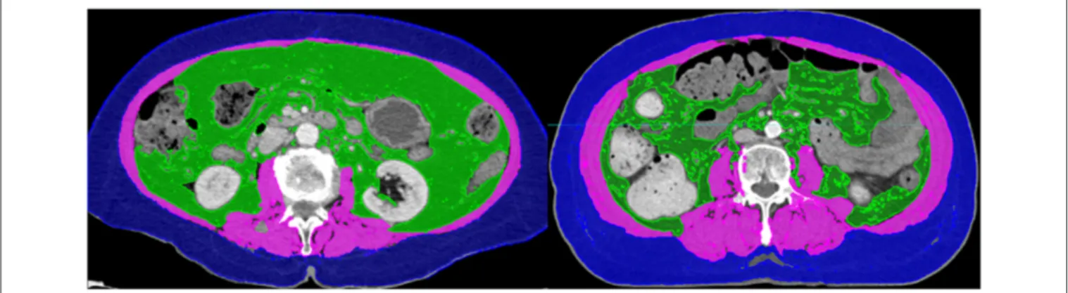 FIGURE 1 | Computed tomography images of patients with (Left) and without sarcopenia (Right)