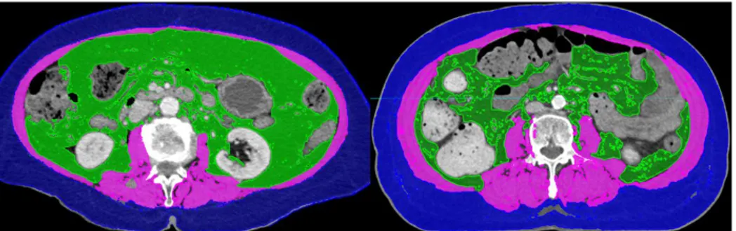 Figure  1.The  computed  tomography  (CT)  images  of  patients  with  sarcopenia (left) and without sarcopenia (right) who had similar body mass  index