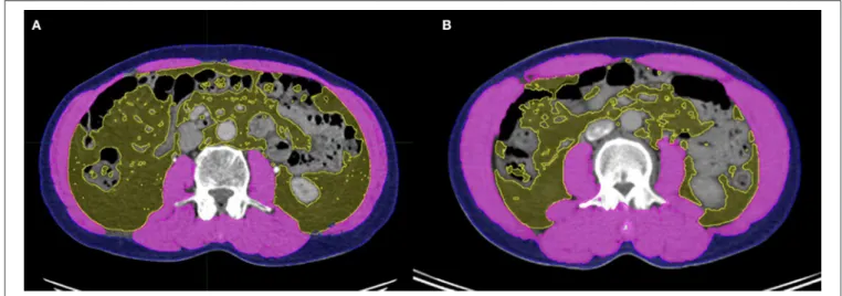 FIGURE 1 | Slices of computed tomography (CT) images of patients with (A) and without (B) sarcopenia who had similar body mass indices