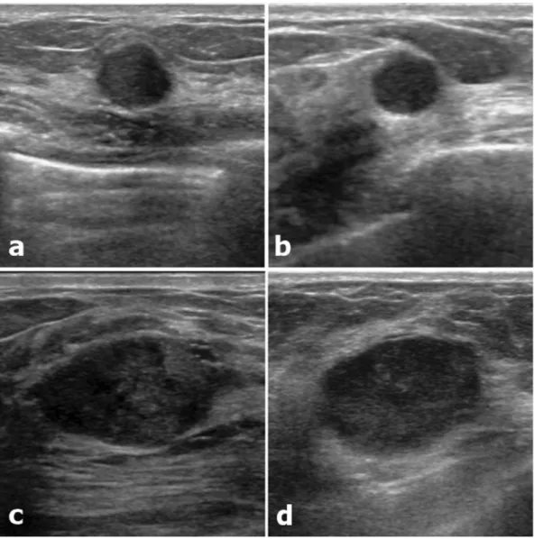Figure 3.  Two couples of similar lesions with differences in the radiomics score. (a) A 10mm-sized round, 