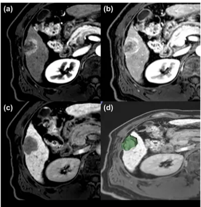 Figure 4. A representative case for poor prognosis. Magnetic resonance imaging  findings  for  a  representative  case  involving  a  54-year-old  male  exhibiting  a  3.0-cm hepatocellular carcinoma (HCC)