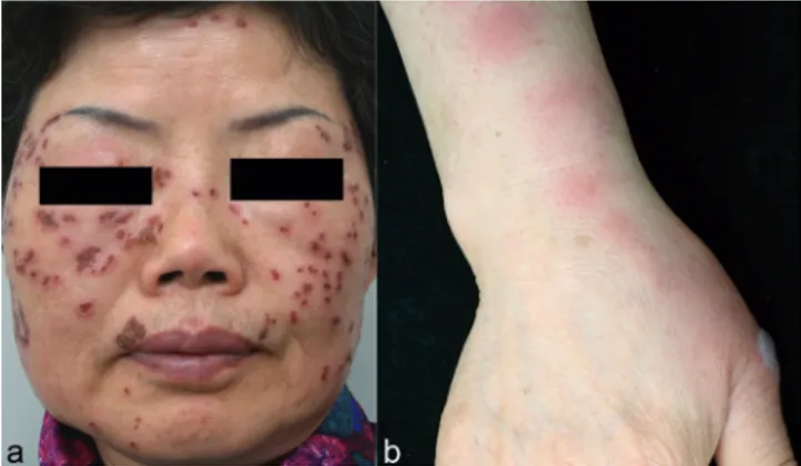 Fig.  1.  (a)  Multiple  erythematous  and  encrusted  ulcerations  on  the  face 