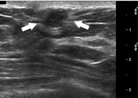 Figure 3. Sonogram obtained 6 months after image in Figure 2 shows a new pal-