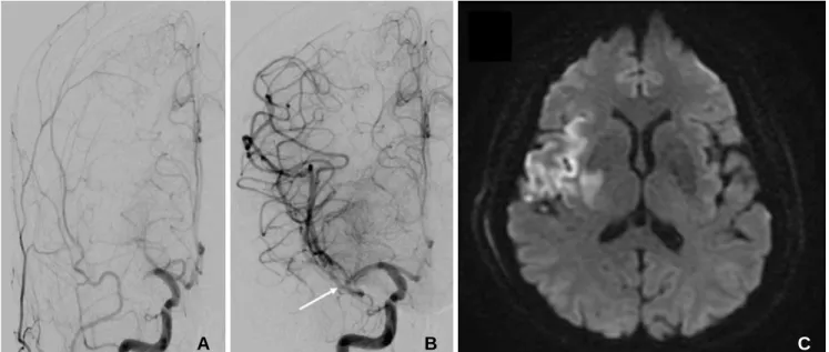 Fig. 2. Axial (A) and coronal (B) contrast-enhanced abdominal computed tomography (CT) reveal right renal subcapsular hematoma