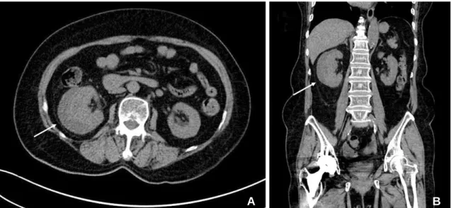 Fig. 3. Axial (A) and coronal (B) non-contrast abdominal CT performed 4 weeks after initial CT show decreased volume of the subcapsu-