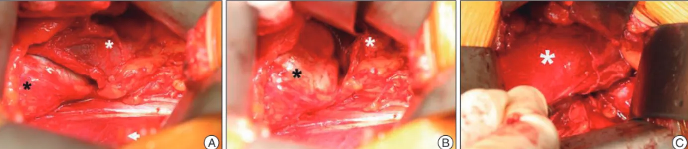 Fig. 4. Intraoperative view. A : Right kidney (white asterisk) and the arachnoid cyst (black asterisk) were exposed after the peritoneum (white arrow 