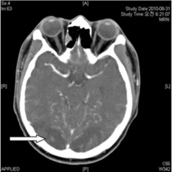 Fig. 3. (A) T2 weighted MR image performed 1 day after seizure shows bilateral patchy increased signal intensity with gyral swelling in both cerebellar hemisphere, parieto-occipital cortex and  subcor-tical white matter area
