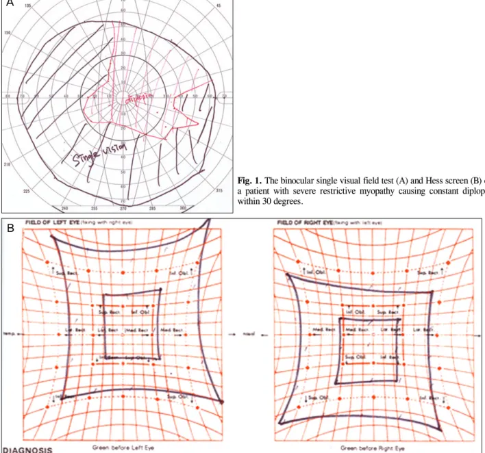 Fig. 1. The binocular single visual field test (A) and Hess screen (B) of 