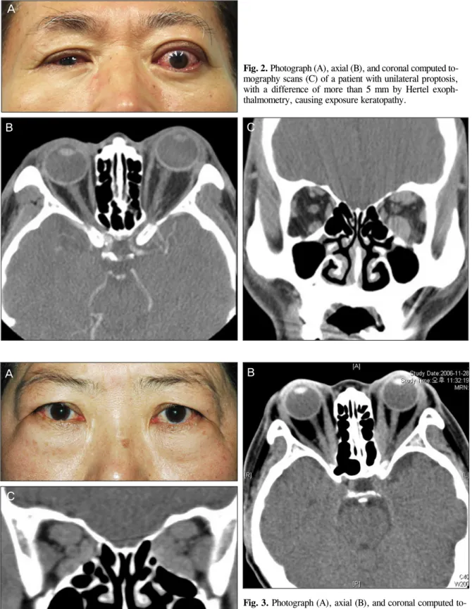 Fig. 2. Photograph (A), axial (B), and coronal computed to-