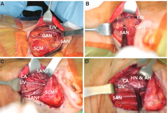 FIG. 2. Upper neck dissection via a retroauricular approach under direct visualization