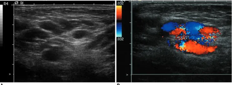 Fig. 1. A. Ultrasonography revealed a 4-cm mass in the left groin and the mass is composed of multiple echo free serpentine tubular channels
