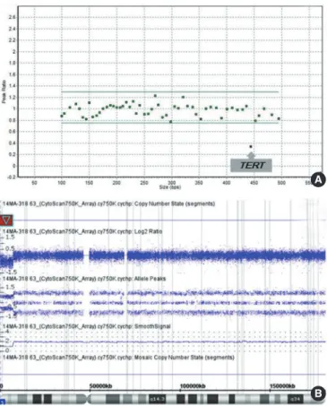 Fig. 1.  Multiplex ligation-dependent probe amplification (MLPA)  and microarray results of patient with Cri du Chat syndrome