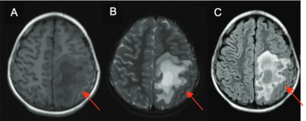 Figure 1. Initial brain MRI shows demyelinating lesion at left fronto-parietal white matter