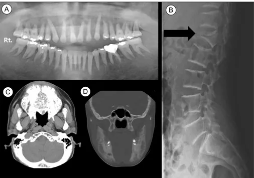 Fig.  1.  Initial  radiologic  findings.  (A)  Panoramic  view  of  maxilla  and  mandible:  Multifocal  bone  demineralization  is  noted  on  both  jaws