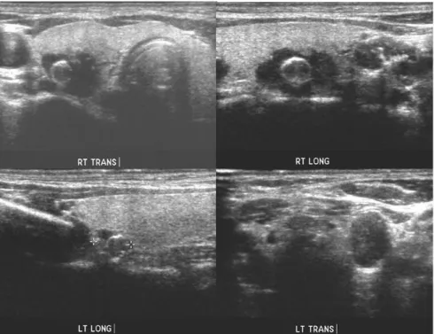 Fig.  3.  Neck  ultrasonography:  dense  calcified  or  non-calcified  rim  lesions,  suspicious  of  parathyroid  gland.