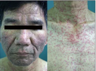 Fig. 1. Multiple pinhead to rice-sized erythematous pustules on the face and upper trunk.