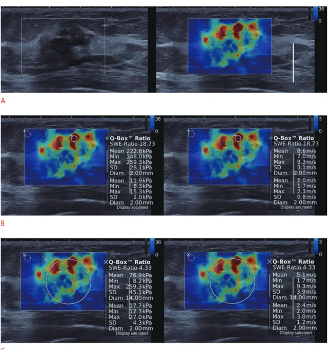 Table 1 summarizes the means of the Emax, Emean, SD, and wSD  of the lesions in kPa and m/sec