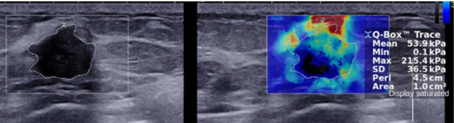 Fig. 2.  A 42-year-old woman with a pathologically proven invasive ductal carcinoma. A freehand region of interest was drawn manually  by tracing the border of the mass using shear-wave elastography to measure lesion elasticity.