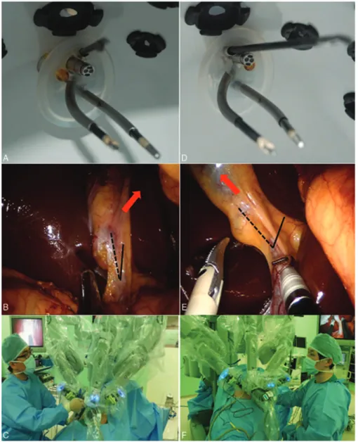 FIGURE 2. Internal view of the direction of the assistant port using (A) the original port and (D) the reverse port