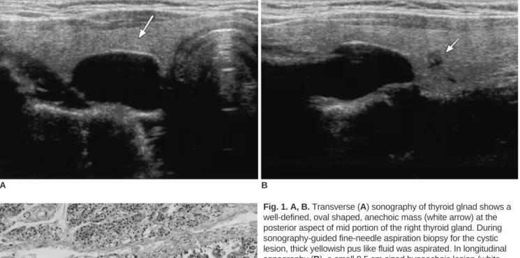 Fig. 1. A, B. Transverse (A) sonography of thyroid glnad shows a